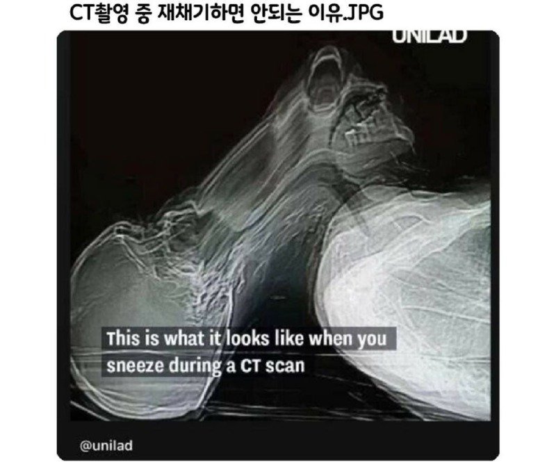Ct촬영 중에 재채기하면 안되는 이유
