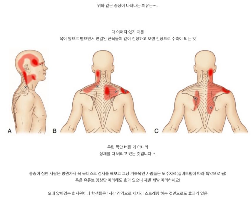 사람들이 잘 모르는 거북목, 목 디스크 증상